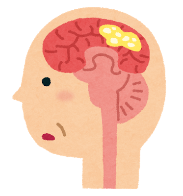 レビー小体型認知症の特徴